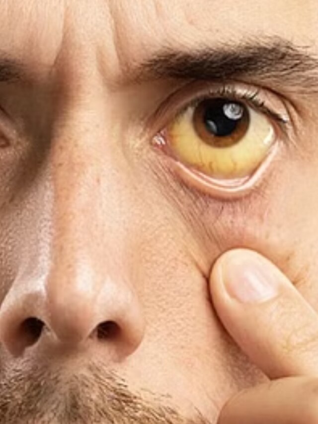 এক সপ্তাহেই ছুমন্তর হবে জন্ডিস, পাতে রাখুন এই ৭ খাবার