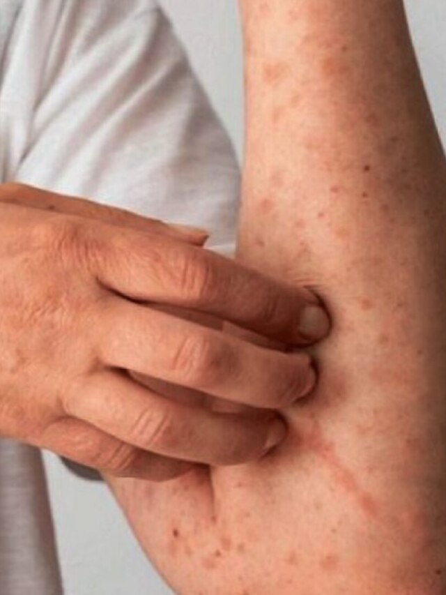 পাউডার দিলে ঘামাচি বাড়ে, ঘরের এই জিনিসেই বাপ বাপ বলে পালাবে