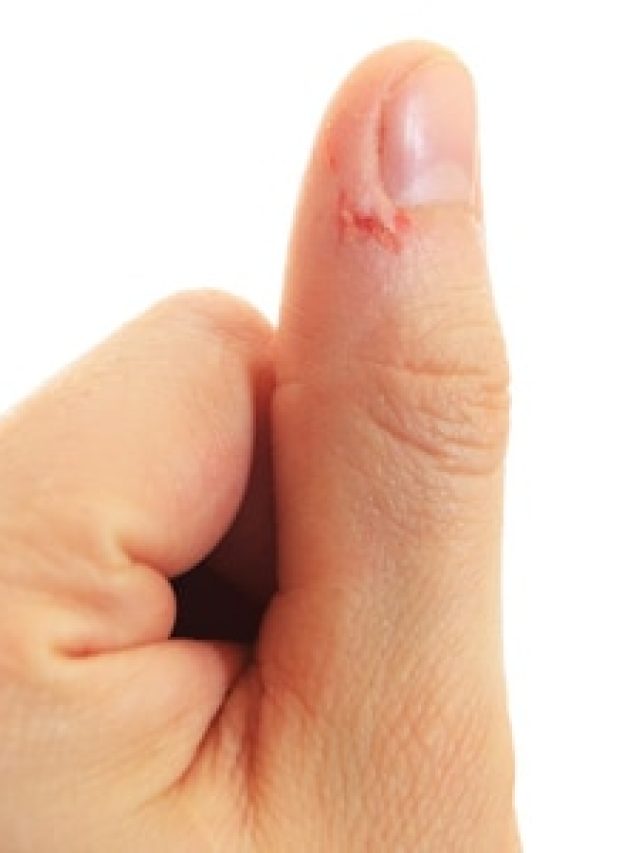 দাঁত দিয়ে নখ কাটতে গিয়ে চামড়া উঠে একসাকাণ্ড, এই উপায়ে ব্যথা কমবে নিমেষে