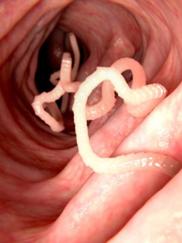 পায়খানা থেকে বেরোচ্ছে সাদা ল্যাকল্যাকে কৃমি? ঘেন্না পাওয়ার আগেই এভাবে তাড়ান