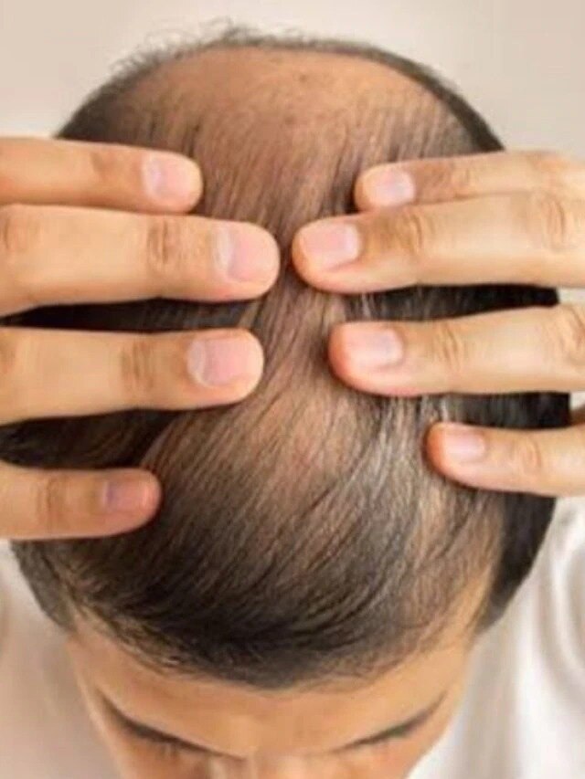 চুল পড়া বন্ধ করতে প্রতিদিন খান এই খাবার, ১ সপ্তাহেই দূর হবে সমস্যা