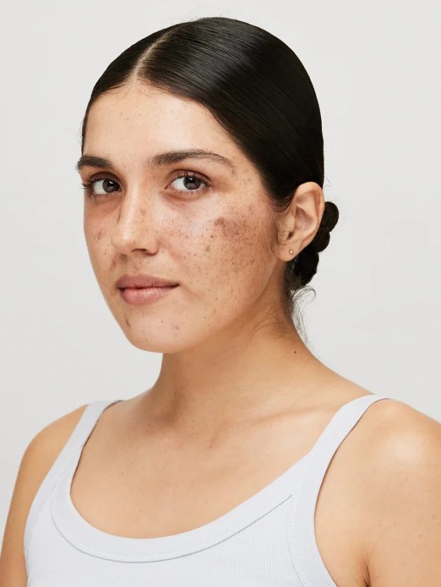 উধাও হবেই পিগমেন্টেশনের দাগ, মুখে এই ২ জিনিস একসঙ্গে লাগান