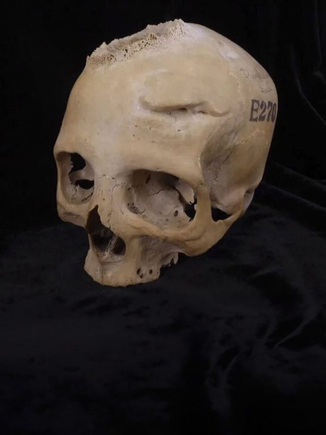 4000-year-old skull reveals ancient Egyptians were researching on treatment of cancer