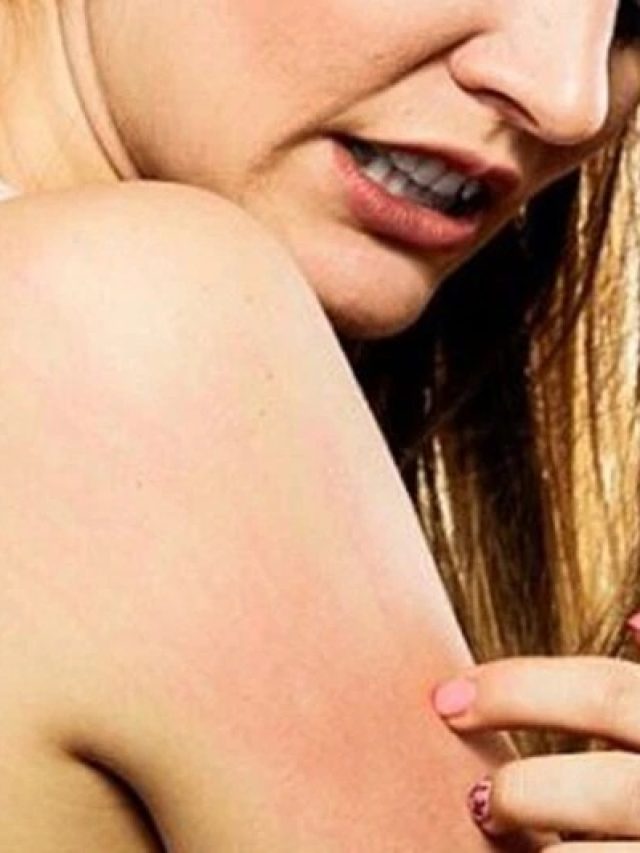 ২৪ ঘণ্টায় বাপ বাপ বলে পালাবে ঘামাচি, জানুন ম্যাজিক উপায়