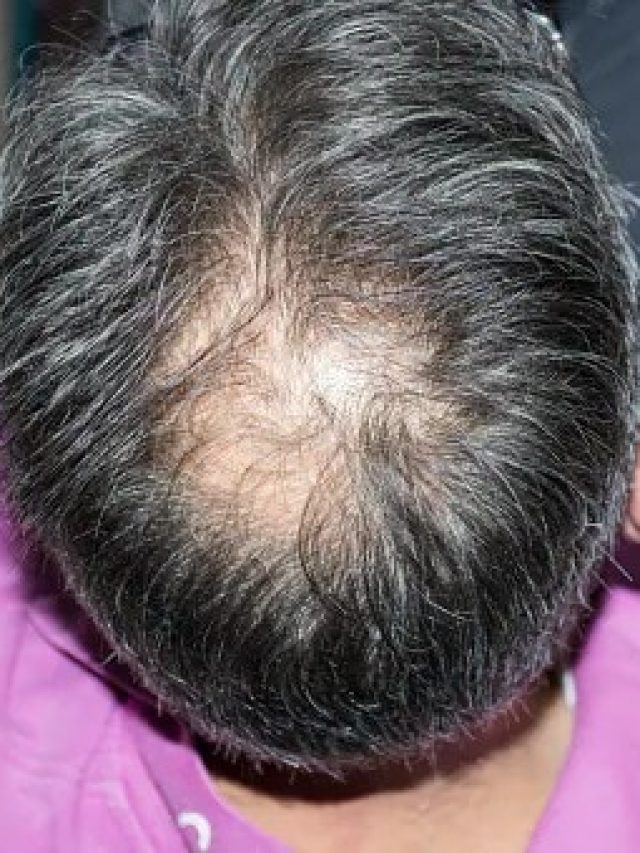 এই ড্রিংকস অজান্তেই কেড়ে নিচ্ছে পুরুষদের মাথার চুল, সাবধান!