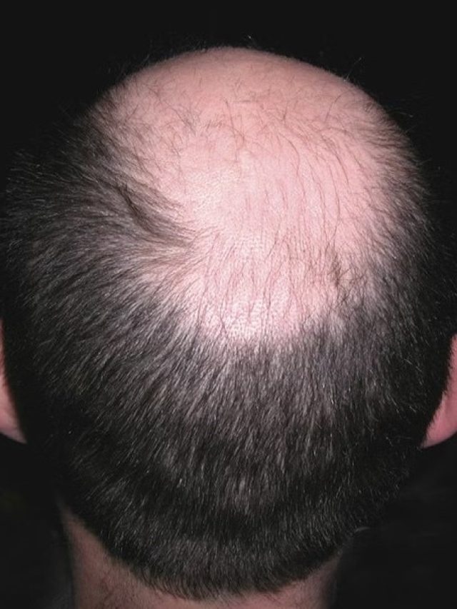 মাথার মাঝখানে টাক? নতুন চুল গজাবে, তেলে মেশান কালো এই মশলা