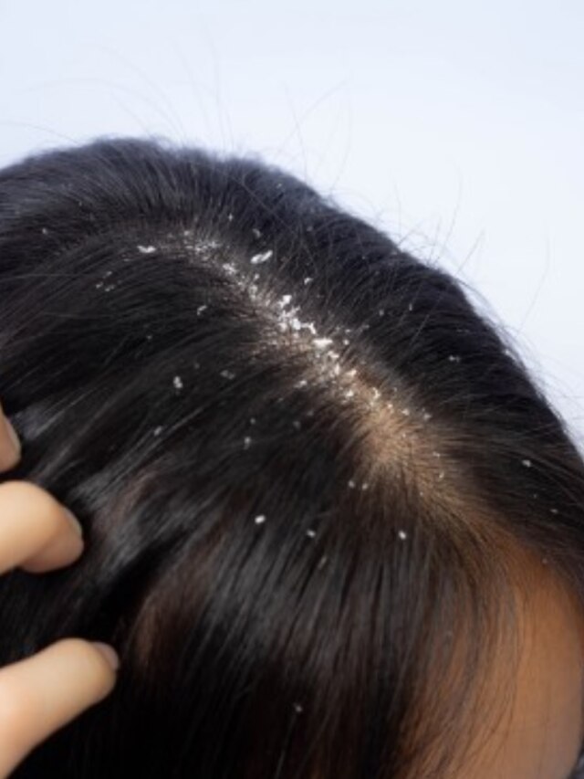 শ্যাম্পু ছাড়ুন, এই পাতা বেটে মাখলেই খুশকি বাপ বাপ বলে পালাবে