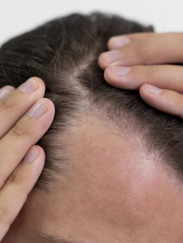 টাকে চুল ফেরাবেন কীভাবে? ডাক্তার যা জানালেন