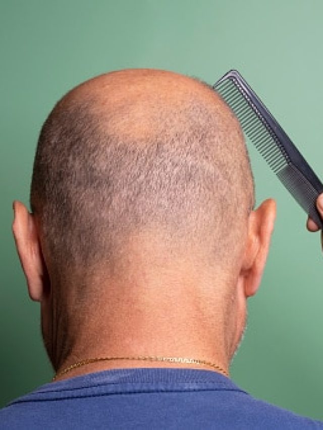 টাক ঢাকতে টাকা নয়, এই কাঁটা গাছের পাতার মালিশে হবে চুলের বাগান