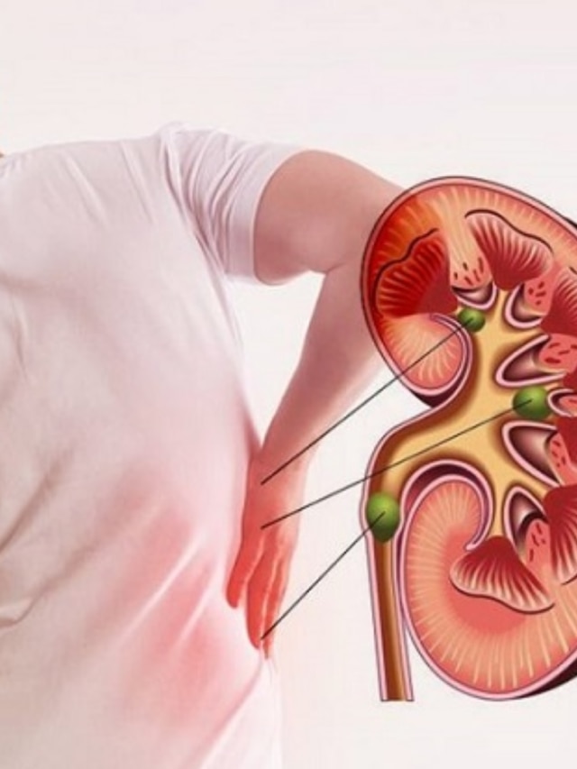 এই মিষ্টি ফলের রস খেলেই প্রস্রাব দিয়ে বেরিয়ে যাবে কিডনি স্টোন