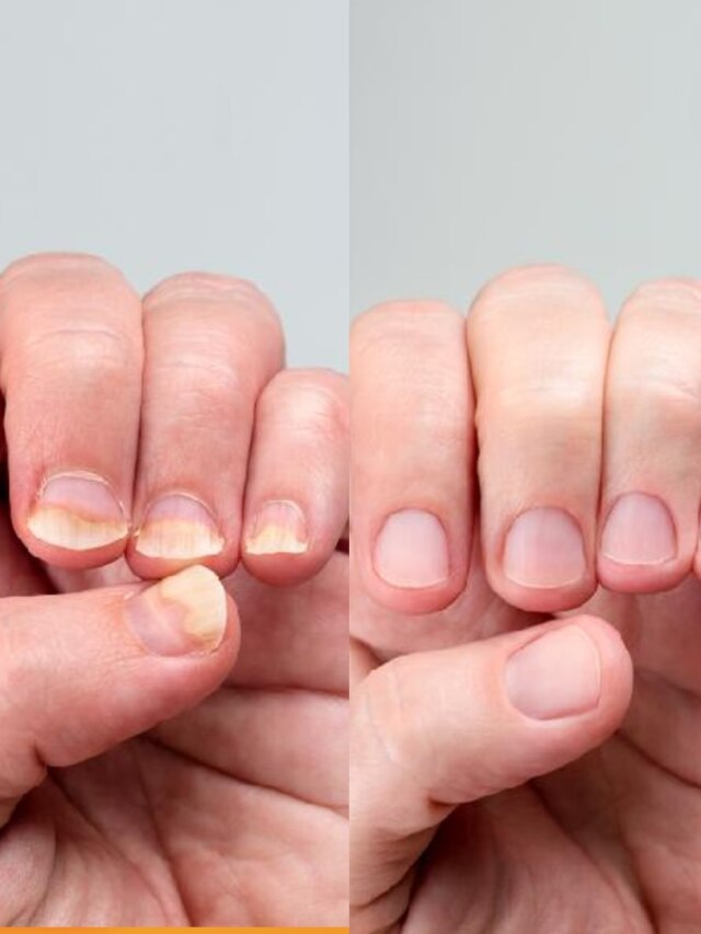 নখ দেখেই বোঝা যাবে রোগ, কোন অসুখে নখে কী উপসর্গ দেখা দেয়