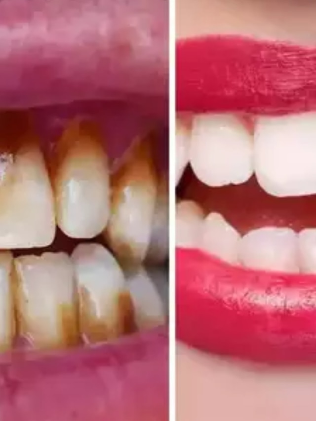 স্মোকিং করে হলুদ দাঁত? রান্নাঘরের এই জিনিসে মাজলেই ঝকঝকে