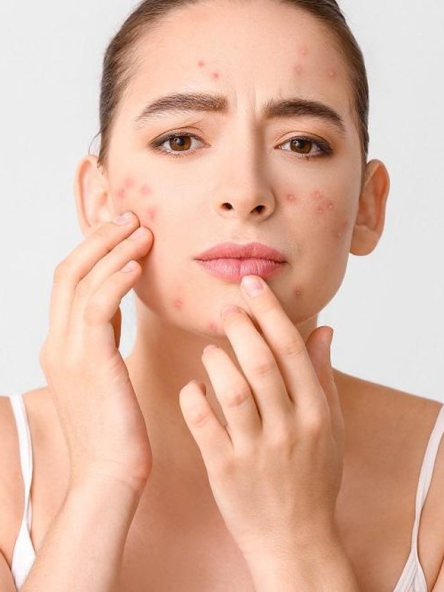 বিশেষ যত্নের পরেও যাচ্ছে  না ব্রণর সমস্যা, এই ৪ ভুল করছেন নাতো?