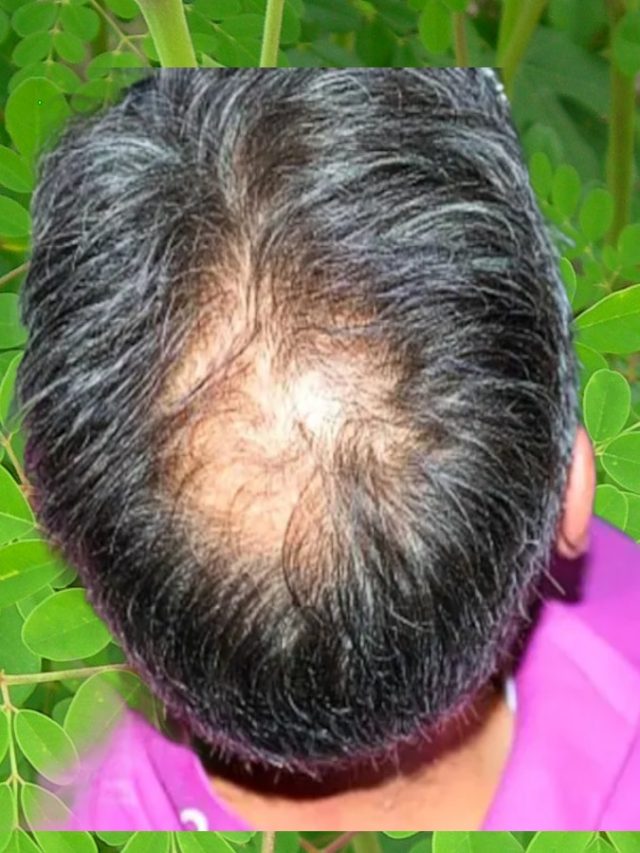 সস্তার এই পাতাতেই হবে কামাল, টাক মাতাতেও হবে ঘন চুল