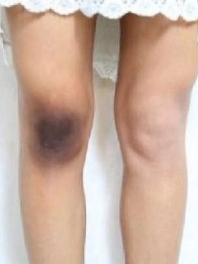 কনুইয়ে কালো দাগ? দূর করতে করুন এই ৩ কাজ