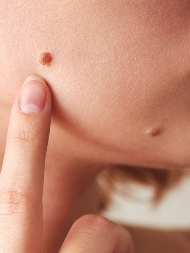 গালে মাছির মতো কালো আঁচিল! সস্তা এই ফলের খোসায় সারবে একরাতে