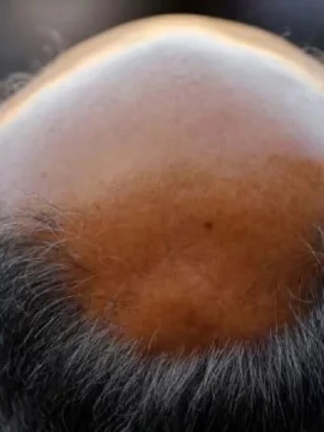 মাথার পিছনে চুল উঠে টাক! এই শাক বেটে লাগালেই ১ মাসে চুলের জঙ্গল