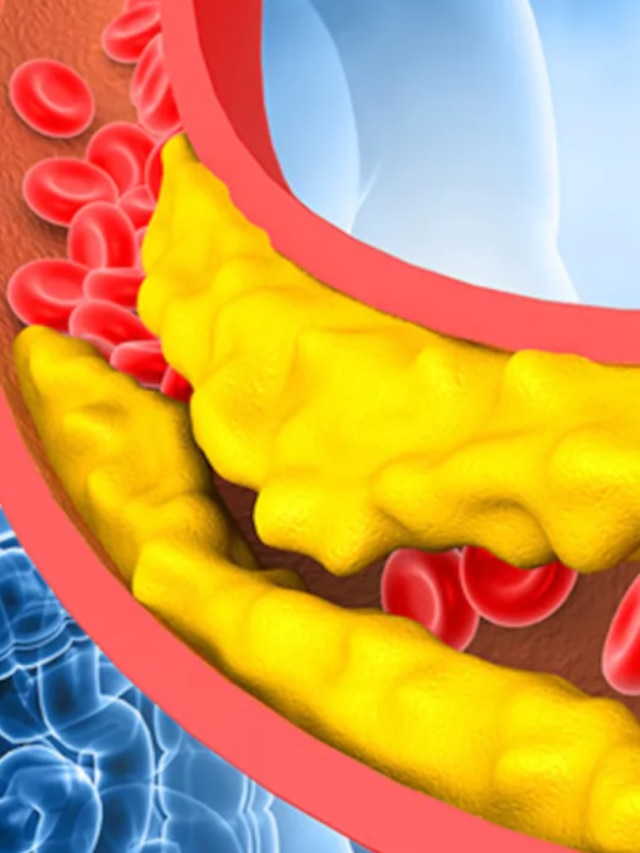 হাই কোলেস্টেরল রয়েছে? এগুলো বাদ দিলেই হৃদরোগের ঝুঁকি কমবে