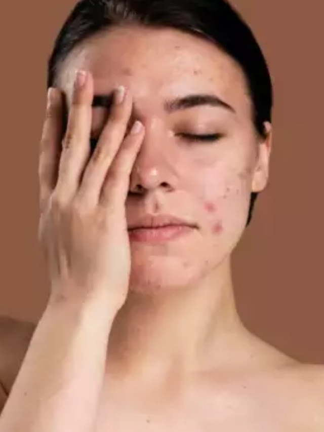 ব্রণর দাগ থেকে স্ট্রেচ মার্ক দূর হবে নিমেষে, রসুনের টোটকাটা জানেন তো?