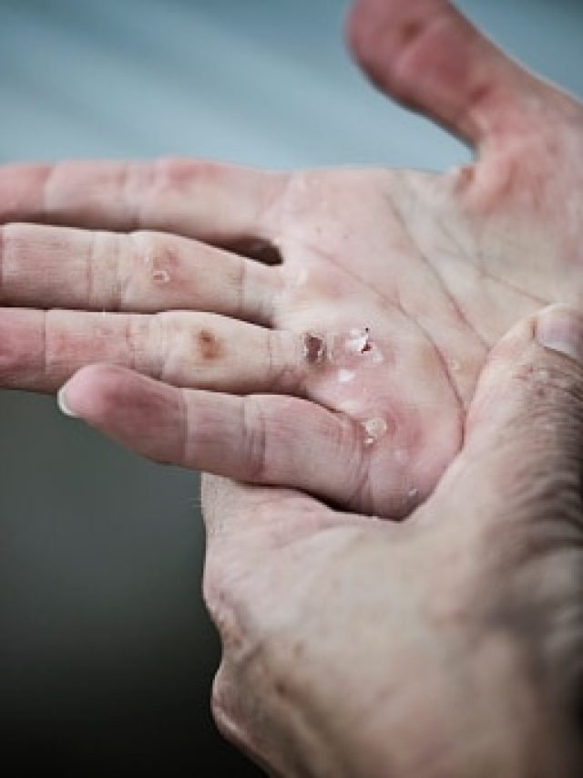 রান্না করতে গিয়ে হাত পুড়েছে? ৬০ সেকেন্ডের এই টোটকায় সঙ্গে সঙ্গে প্রতিকার