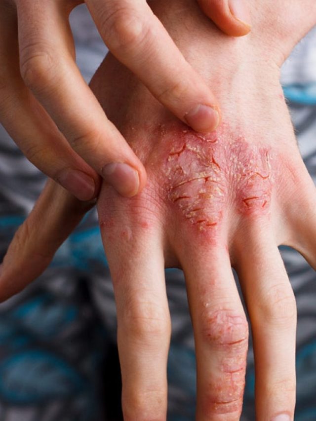 আঙুলের খাঁজে হওয়া হাজা কমবে ৭ দিনে, পেঁয়াজ ঘষুন ভাল করে