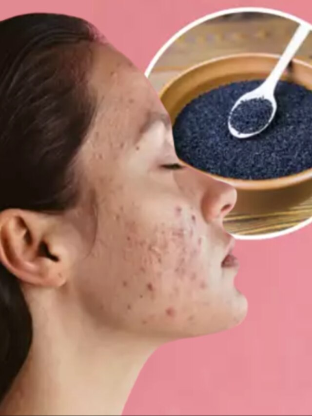 ব্রণ ও দাগ ভর্তি মুখ, এভাবে কালো জিরে মাখলেই ক্লিয়ার স্কিন