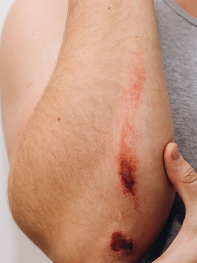 কেটে গিয়ে রক্ত বেরোচ্ছে? এই জিনিসেই নিমেষে বন্ধ, হবে না সেপটিকও