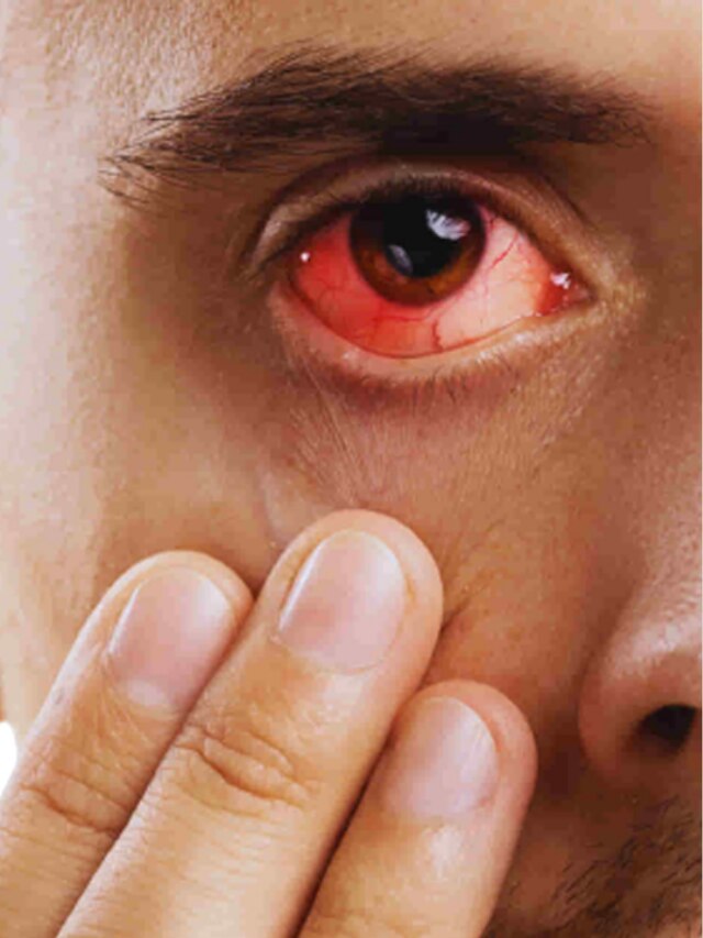 ঘরে ঘরে 'জয় বাংলা', চোখ লাল হলেই দ্রুত করুন এই কাজ, জেনে রাখুন