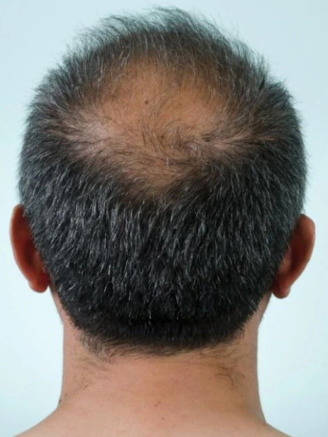 সস্তার এই পাতাই করবে কামাল, টাকে  হবে ঘন চুল