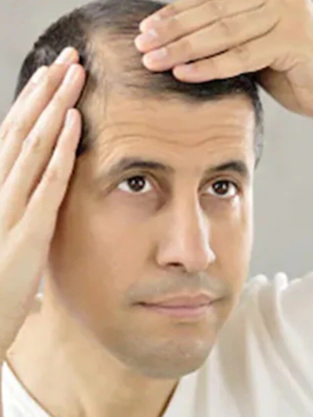 টাক মাথা হবে চুলে পরিপূর্ণ, ব্যবহার করুন ট্রিকস