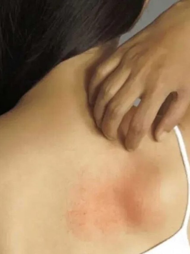 ঘামাচির খোঁচা থেকে চটজলদি মুক্তির সহজ উপায়, অনেকে জানেই না