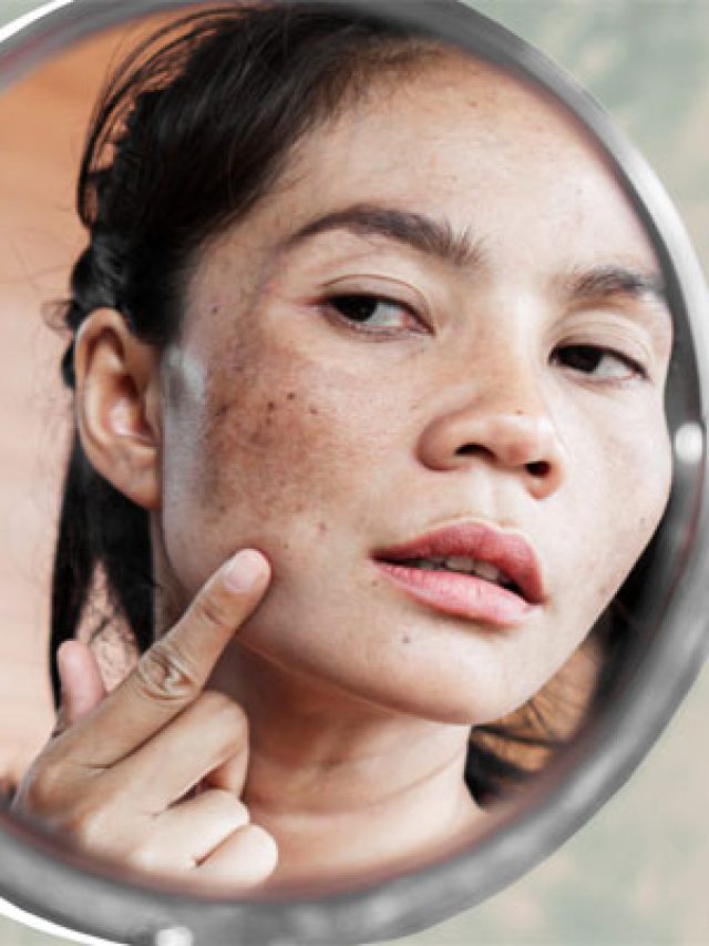 ছুলিতে ভরেছে মুখ? এক পয়সা খরচা না করেও গায়েব করুন এভাবে