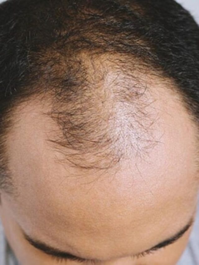 কে বলেছে টাকে চুল গজায় না? এই জিনিস লাগালেই মাথা ভরবে চুলে