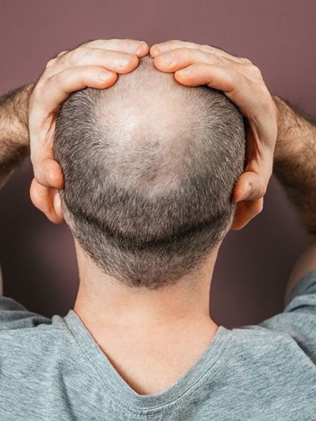 টাকলা মাথাতেও গজাবে কালো চুল, তেলের বদলে মাখুন বিরিয়ানির এই জিনিস