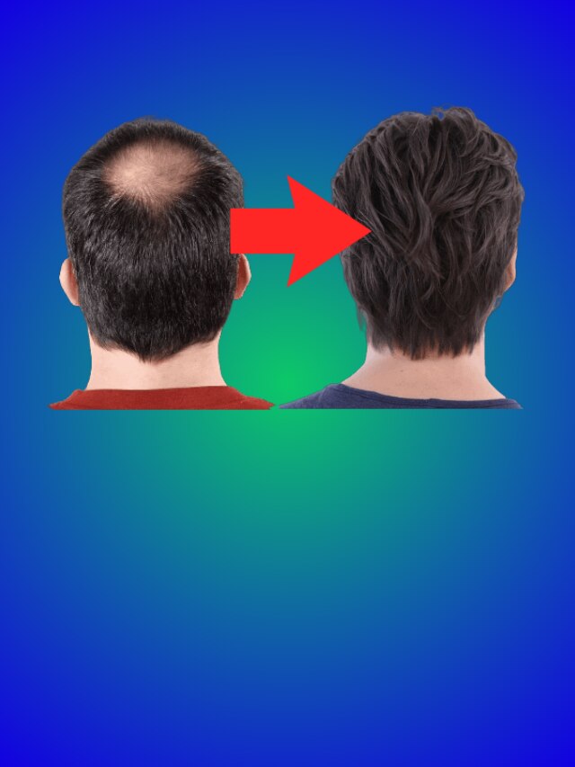 মাত্র এক মাসেই টাকে চুল গজাবে, করতে হবে এই জিনিস