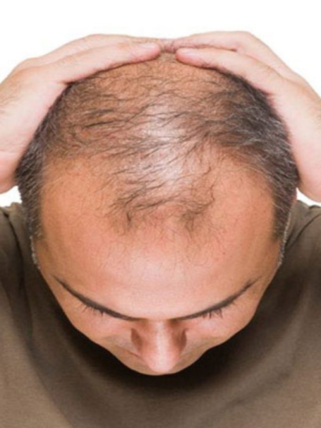 টাক মাথাতেও আবার নতুন চুল গজাবে,শুধু এই জিনিসটি শ্যাম্পুতে মিশিয়ে লাগান