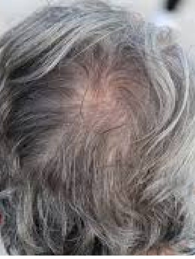 तेजी से सफेद हो रहे हैं बाल? आचार्य बालकृष्ण से जानें काले करने का आसान उपाय