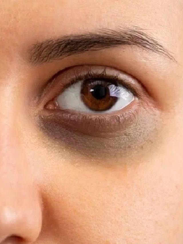 মাত্র ৭ দিনে গায়েব হবে ডার্ক সার্কেল, রইল গোপন ৫ টিপস