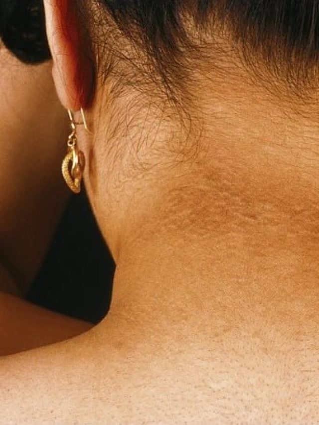 ঘাড়ের কালো দাগ উঠবে ৭দিনে,  রইল পুরনো দিনের টিপস