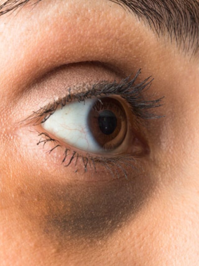 ডার্ক সার্কেল? আমন্ডের এই টোটকায় পুজোর আগেই ছুমন্তর হবে