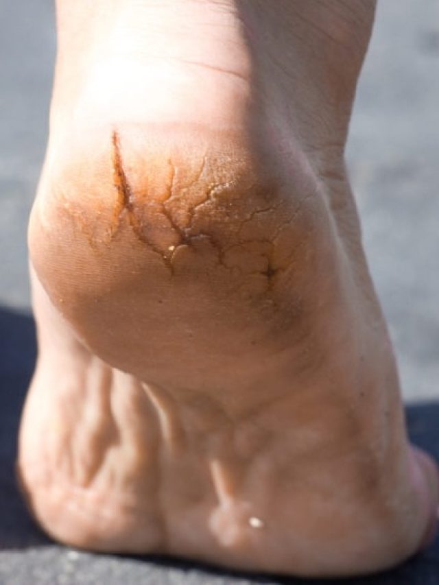 ফাটা গোড়ালি হবে তুলোর মতো নরম, শীত দাদু আসার আগে রইল টিপস