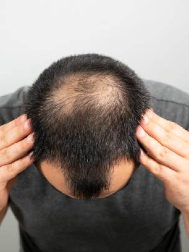 টাকলা মাথায় নতুন চুলের বাগান ৭দিনে, নারকেল তেলে ফেলুন এই সস্তার ফুল