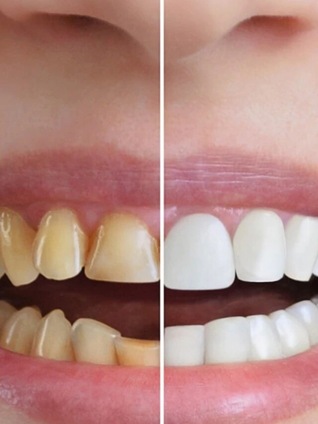 হলুদ দাঁত ২ দিনেই হবে চকচকে সাদা , রইল টিপস
