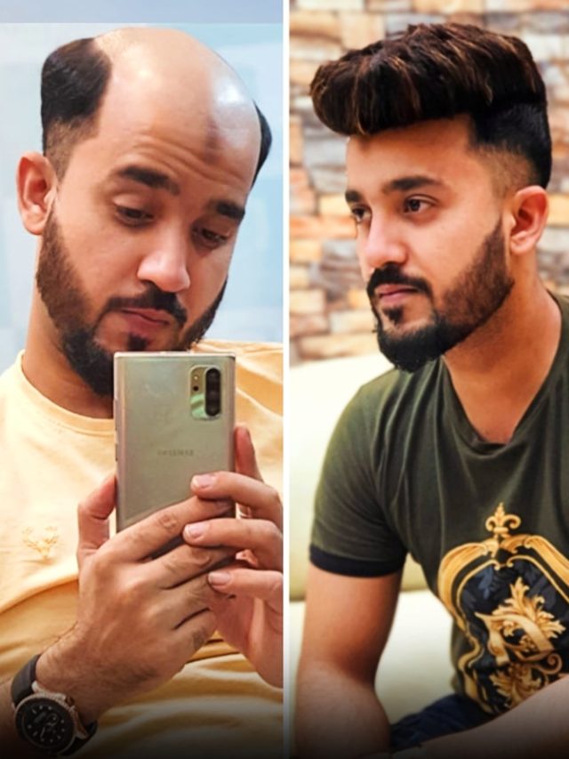 गंजे सिर पर आ गए घने काले बाल...शख्स ने बताया सीक्रेट, आप भी अपना सकते हैं ये तरीका