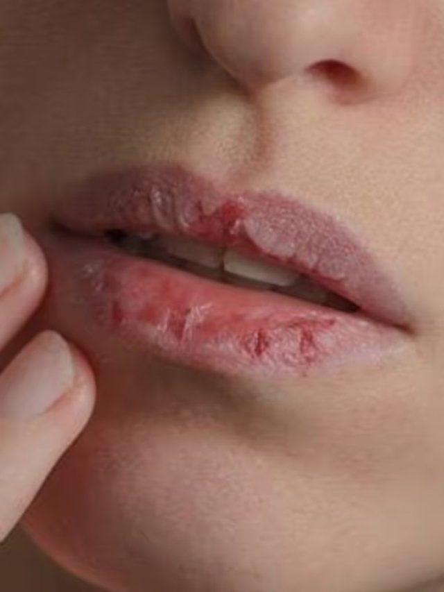 শীত আসার আগেই ঠোঁট ফাটা শুরু? এই ২ ভিটামিন দায়ী নয় তো?