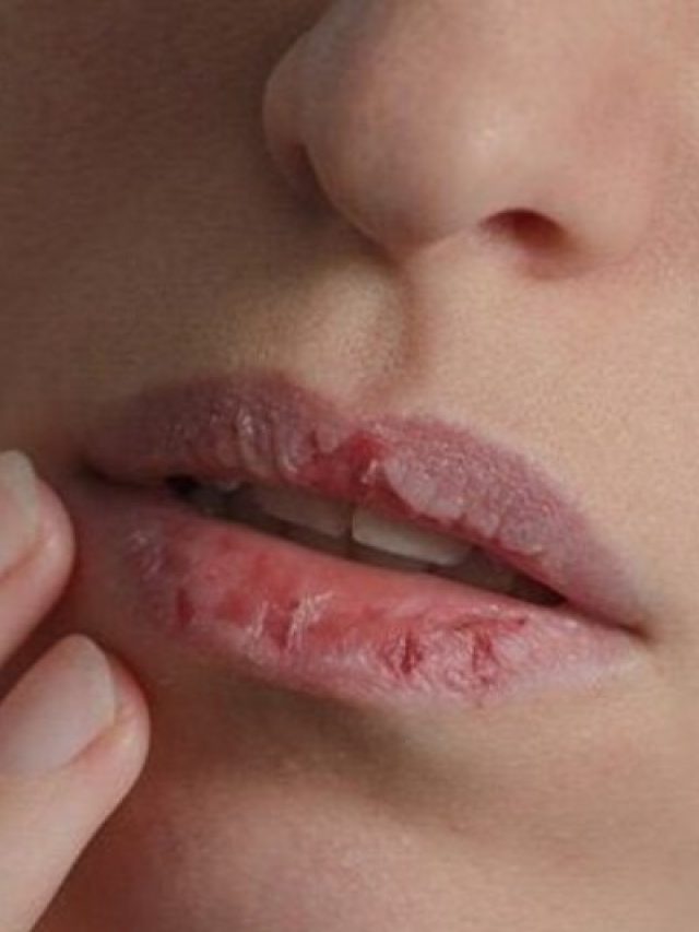 किस विटामिन की कमी से फटते हैं होंठ? जानिए