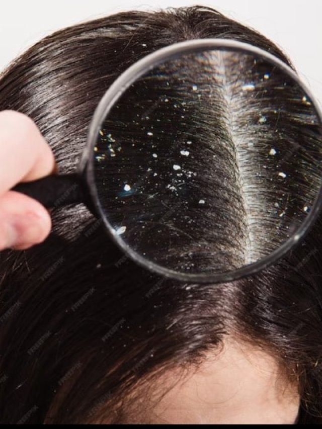 किस विटामिन की कमी से सिर में होता है डैंड्रफ? जानिए