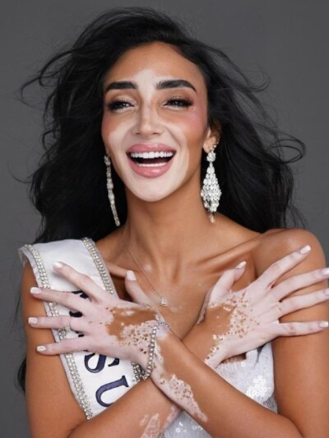 जब 'सफेद दाग वाली लड़की' ने मिस यूनिवर्स में जीता दिल, देखें बेस्ट लुक्स, PHOTOS