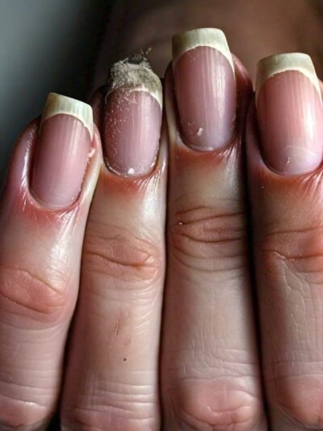 किस विटामिन की कमी से जल्दी-जल्दी टूटते हैं नाखून? जानिए