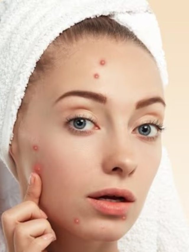 किस विटामिन की कमी से चेहरे पर निकलते हैं पिंपल्स? जानिए